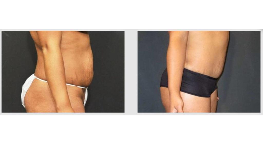 A Before and After photo of a Liposuction Plastic Surgery by Dr. Craig Jonov in Seattle and Tacoma