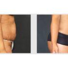 A Before and After photo of a Liposuction Plastic Surgery by Dr. Craig Jonov in Seattle and Tacoma