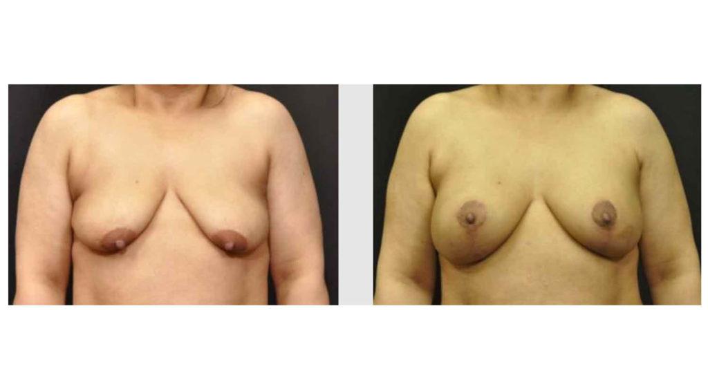 A Before and After photo of a Breast Augmentation Plastic Surgery by Dr. Craig Jonov in Seattle and Tacoma