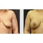 A Before and After photo of a Breast Augmentation Plastic Surgery by Dr. Craig Jonov in Seattle and Tacoma