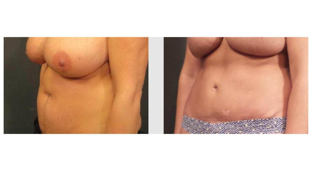 Tummy Tuck Seattle. Tummy Tuck before and after photos by Dr. Craig Jonov at Seattle Plastic Surgery.