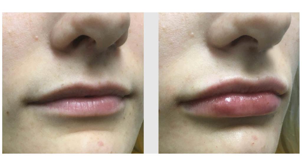 A Before and After photo of Filler injections at Seattle Plastic Surgery in Seattle and Tacoma