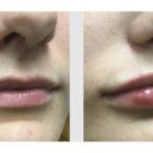 A Before and After photo of Filler injections at Seattle Plastic Surgery in Seattle and Tacoma