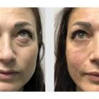 A Before & After Photo of Under Eye Filler In SEattle and Tacoma