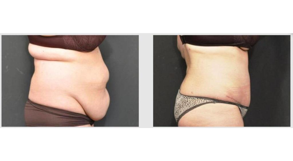 A Before and After photo of a Liposuction Plastic Surgery by Dr. Craig Jonov in Seattle and Tacoma
