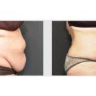 A Before and After photo of a Liposuction Plastic Surgery by Dr. Craig Jonov in Seattle and Tacoma