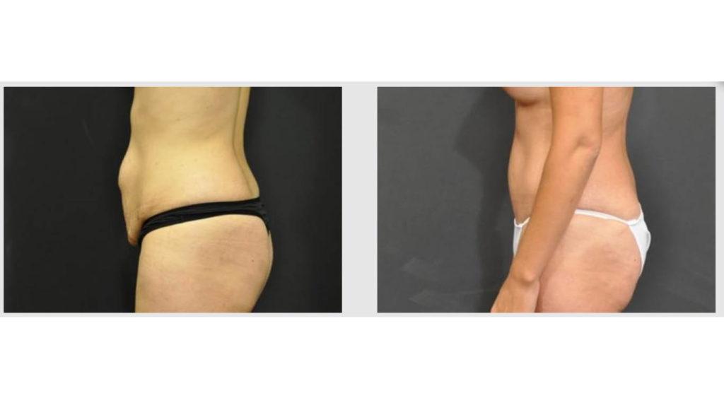 A Before and After photo of a Tummy Tuck Plastic Surgery by Dr. Craig Jonov in Seattle and Tacoma