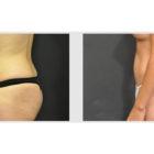 A Before and After photo of a Tummy Tuck Plastic Surgery by Dr. Craig Jonov in Seattle and Tacoma