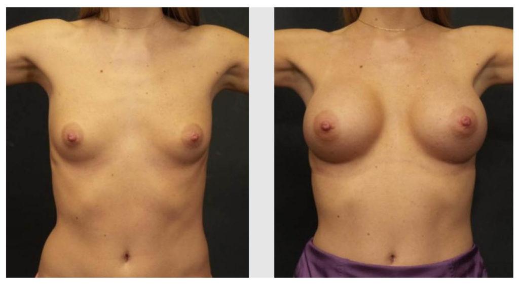 A Before and After photo of a Breast Augmentation Plastic Surgery by Dr. Craig Jonov in Seattle and Tacoma