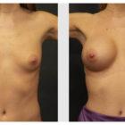 A Before and After photo of a Breast Augmentation Plastic Surgery by Dr. Craig Jonov in Seattle and Tacoma