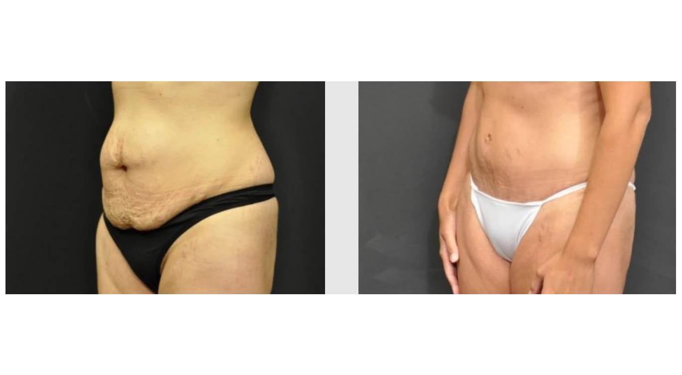 A Before and After photo of a Tummy Tuck Plastic Surgery by Dr. Craig Jonov in Seattle and Tacoma