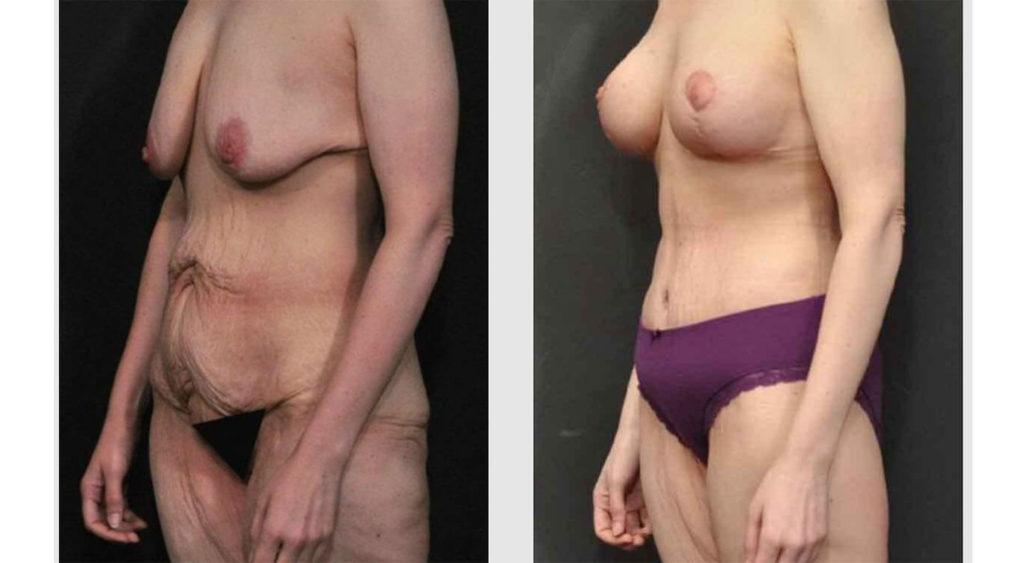 A Before and After photo of a Liposuction Plastic Surgery by Dr. Craig Jonov in Seattle and Tacoma