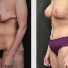 A Before and After photo of a Liposuction Plastic Surgery by Dr. Craig Jonov in Seattle and Tacoma