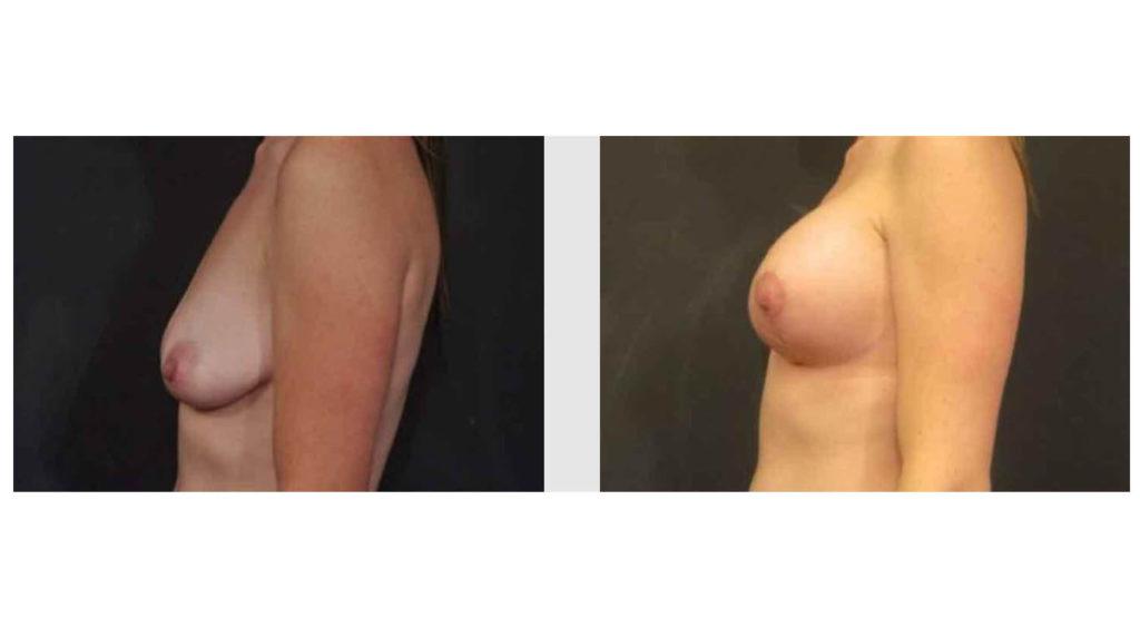 A Before and After photo of a Breast Augmentation Plastic Surgery by Dr. Craig Jonov in Seattle and Tacoma