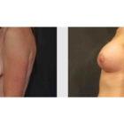 A Before and After photo of a Breast Augmentation Plastic Surgery by Dr. Craig Jonov in Seattle and Tacoma