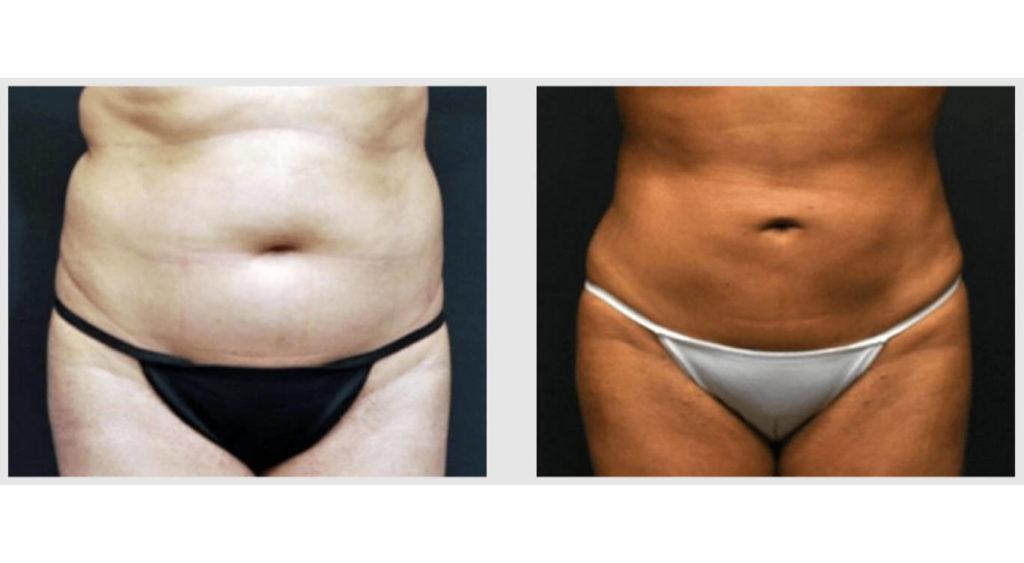 A Before and After photo of a Liposuction Plastic Surgery by Dr. Craig Jonov in Seattle and Tacoma