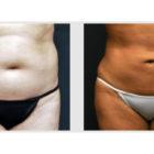 A Before and After photo of a Liposuction Plastic Surgery by Dr. Craig Jonov in Seattle and Tacoma