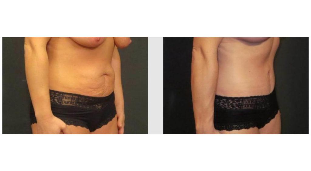 A Before and After photo of a Tummy Tuck Plastic Surgery by Dr. Craig Jonov in Seattle and Tacoma