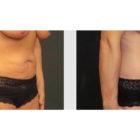 A Before and After photo of a Tummy Tuck Plastic Surgery by Dr. Craig Jonov in Seattle and Tacoma