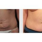 A Before and After photo of a Tummy Tuck Plastic Surgery by Dr. Craig Jonov in Seattle and Tacoma