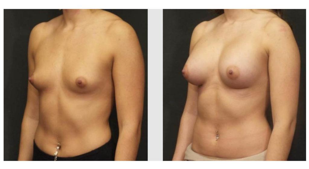 A Before and After photo of a Breast Augmentation Plastic Surgery by Dr. Craig Jonov in Seattle and Tacoma