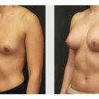 A Before and After photo of a Breast Augmentation Plastic Surgery by Dr. Craig Jonov in Seattle and Tacoma