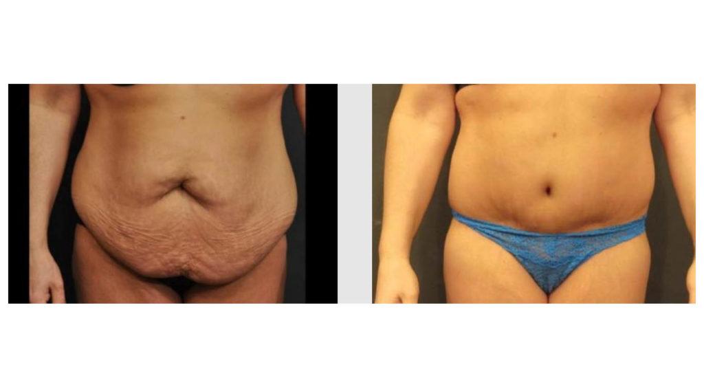 A Before and After photo of a Tummy Tuck Plastic Surgery by Dr. Craig Jonov in Seattle and Tacoma
