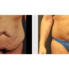 A Before and After photo of a Tummy Tuck Plastic Surgery by Dr. Craig Jonov in Seattle and Tacoma