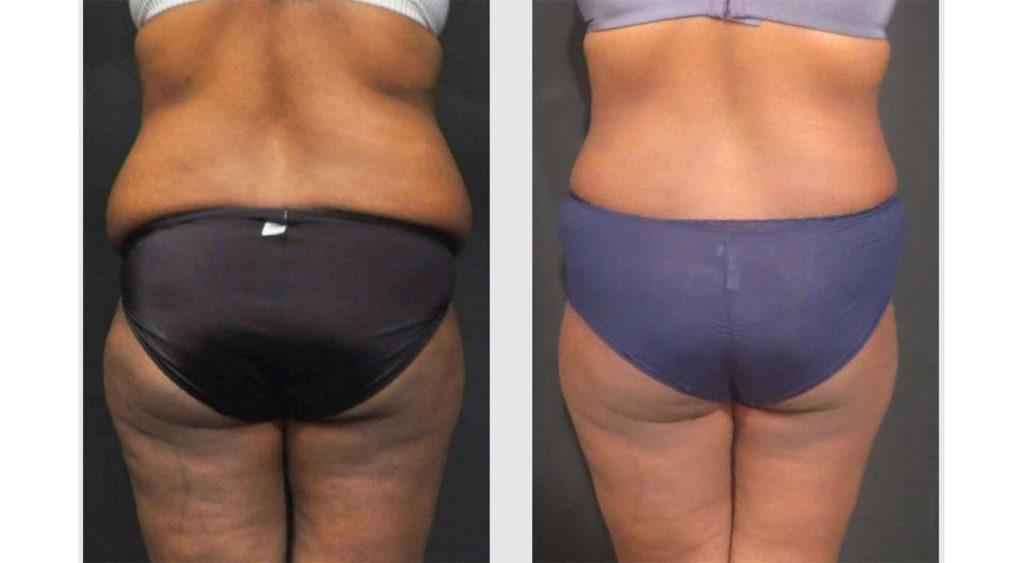 A Before and After photo of a Liposuction Plastic Surgery by Dr. Craig Jonov in Seattle and Tacoma