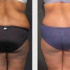 A Before and After photo of a Liposuction Plastic Surgery by Dr. Craig Jonov in Seattle and Tacoma