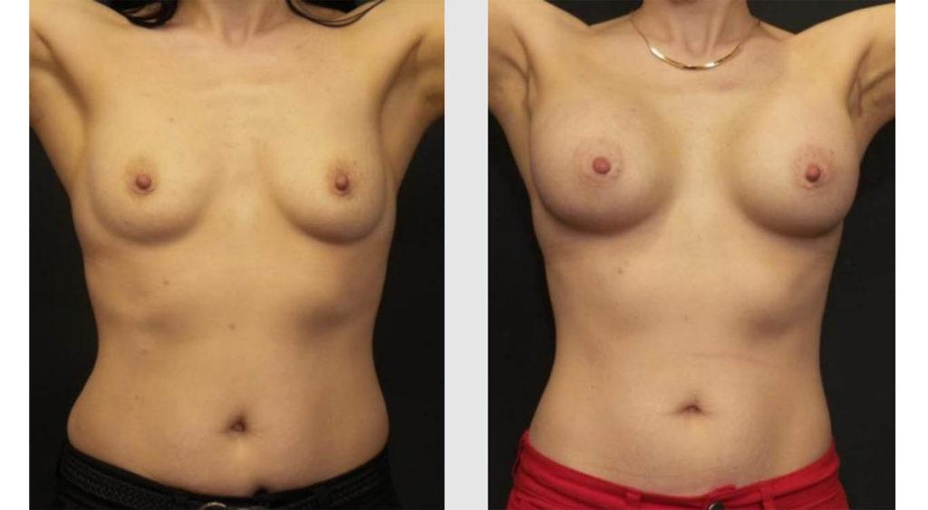 A Before and After photo of a Breast Augmentation Plastic Surgery by Dr. Craig Jonov in Seattle and Tacoma