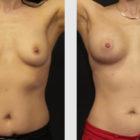 A Before and After photo of a Breast Augmentation Plastic Surgery by Dr. Craig Jonov in Seattle and Tacoma