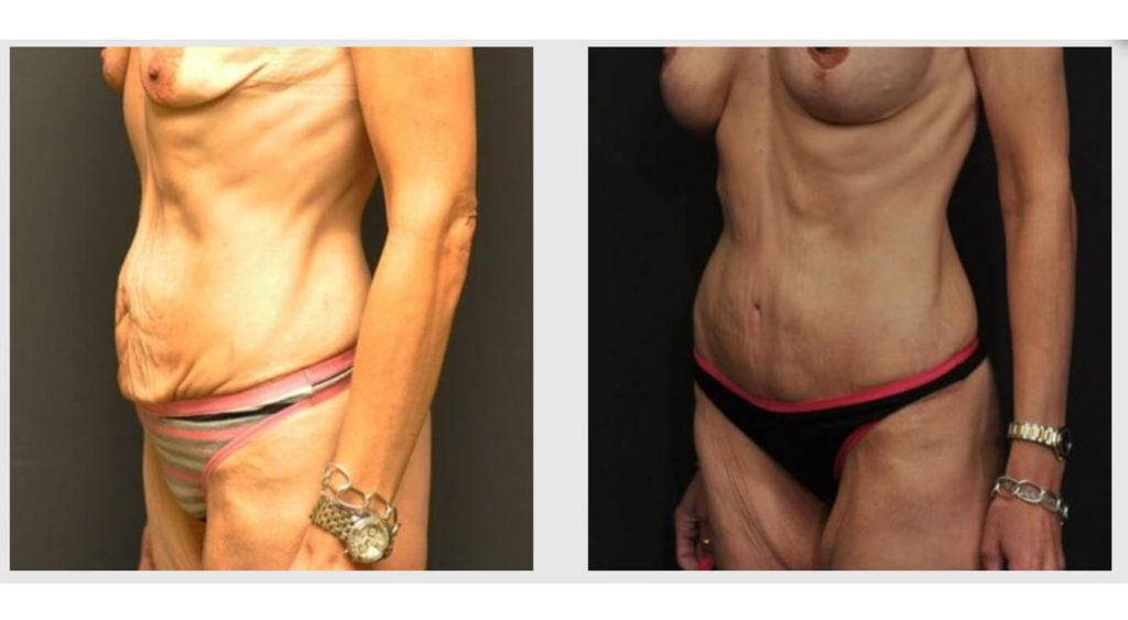 A Before and After photo of a Liposuction Plastic Surgery by Dr. Craig Jonov in Seattle and Tacoma
