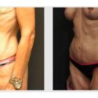 A Before and After photo of a Liposuction Plastic Surgery by Dr. Craig Jonov in Seattle and Tacoma