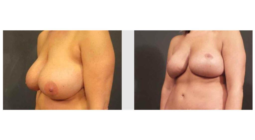 A Before and After photo of a Breast Augmentation Plastic Surgery by Dr. Craig Jonov in Seattle and Tacoma