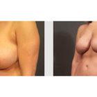 A Before and After photo of a Breast Augmentation Plastic Surgery by Dr. Craig Jonov in Seattle and Tacoma