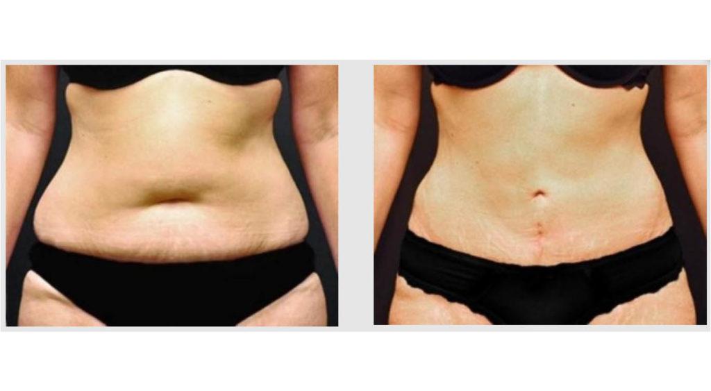A Before and After photo of a Tummy Tuck Plastic Surgery by Dr. Craig Jonov in Seattle and Tacoma