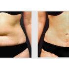 A Before and After photo of a Tummy Tuck Plastic Surgery by Dr. Craig Jonov in Seattle and Tacoma