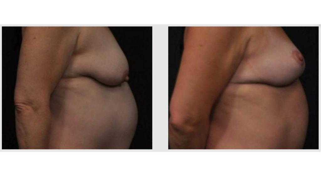 A Before and After photo of a Tummy Tuck Plastic Surgery by Dr. Craig Jonov in Seattle and Tacoma