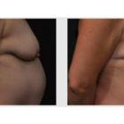 A Before and After photo of a Tummy Tuck Plastic Surgery by Dr. Craig Jonov in Seattle and Tacoma