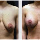 A Before and After photo of a Breast Augmentation Plastic Surgery by Dr. Craig Jonov in Seattle and Tacoma