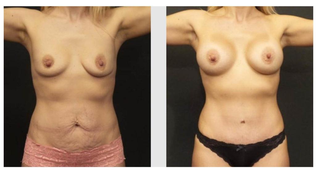 A Before and After photo of a Breast Augmentation Plastic Surgery by Dr. Craig Jonov in Seattle and Tacoma