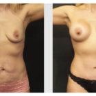 A Before and After photo of a Breast Augmentation Plastic Surgery by Dr. Craig Jonov in Seattle and Tacoma