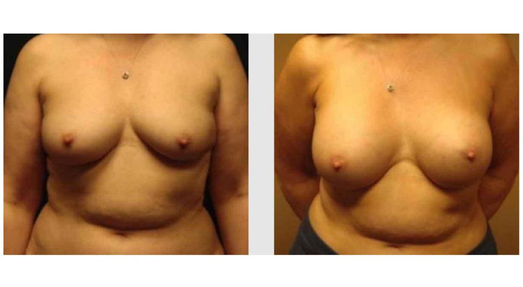 A Before and After photo of a Breast Augmentation Plastic Surgery by Dr. Craig Jonov in Seattle and Tacoma