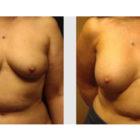 A Before and After photo of a Breast Augmentation Plastic Surgery by Dr. Craig Jonov in Seattle and Tacoma