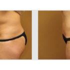 A Before and After photo of a Tummy Tuck Plastic Surgery by Dr. Craig Jonov in Seattle and Tacoma