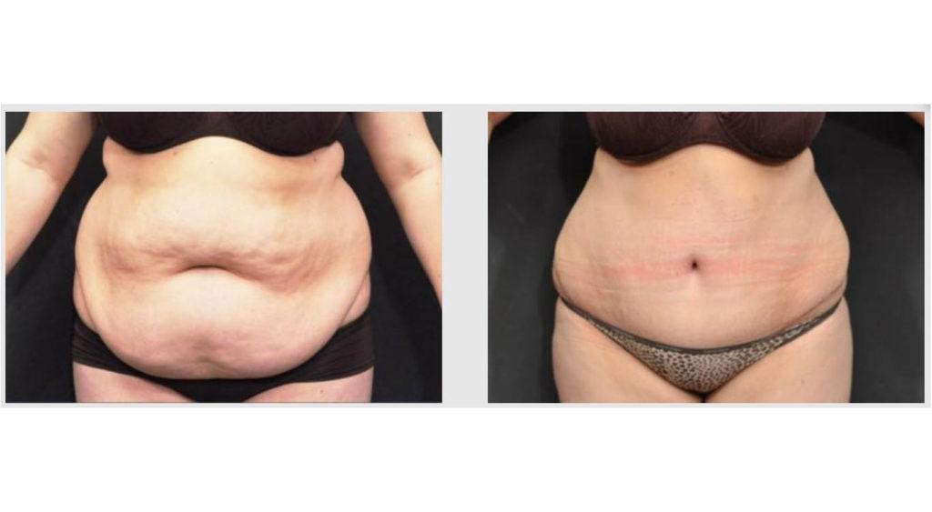 A Before and After photo of a Tummy Tuck Plastic Surgery by Dr. Craig Jonov in Seattle and Tacoma