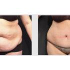 A Before and After photo of a Tummy Tuck Plastic Surgery by Dr. Craig Jonov in Seattle and Tacoma