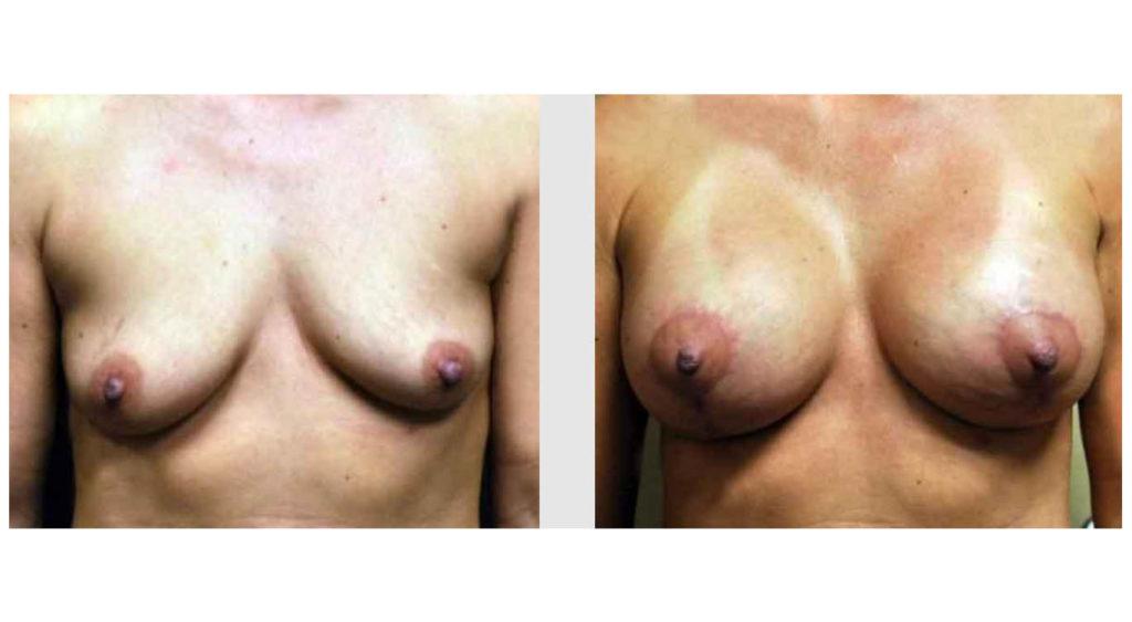 A Before and After photo of a Breast Augmentation Plastic Surgery by Dr. Craig Jonov in Seattle and Tacoma