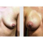 A Before and After photo of a Breast Augmentation Plastic Surgery by Dr. Craig Jonov in Seattle and Tacoma